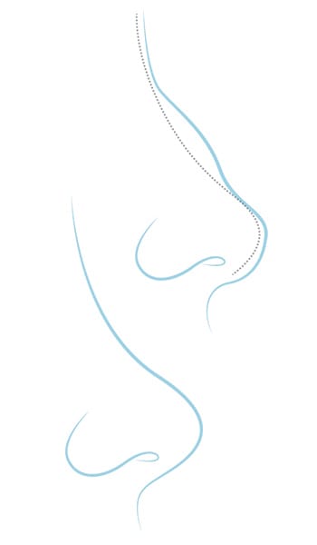 rinoplastia operacion