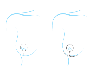 Ilustracion Cirugia Reduccion Pecho