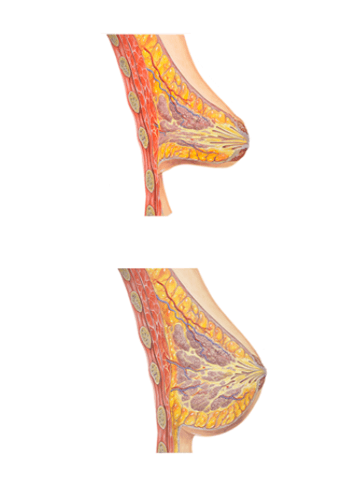 Mamas tuberosas Bilbao