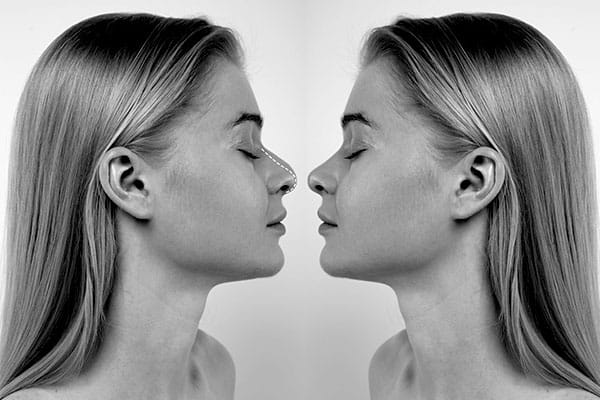 Rinoplastia convencional vs ultreasonica